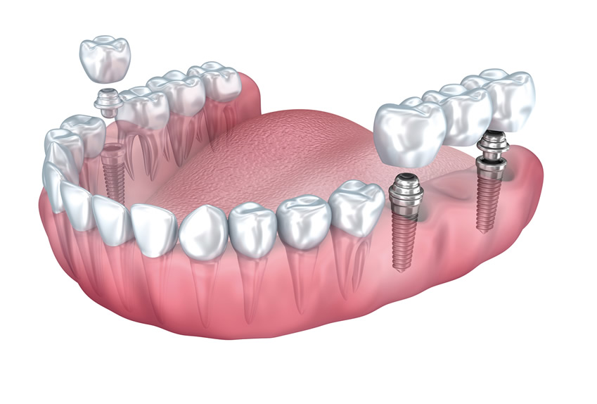 Zahnimplantate werden in den Unterkiefer eingesetzt Grafik
