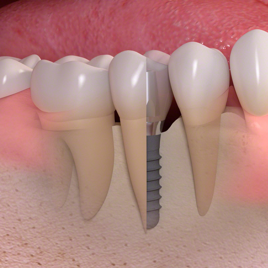 Welche ist die beste Zahnfüllung? - Donau Dental