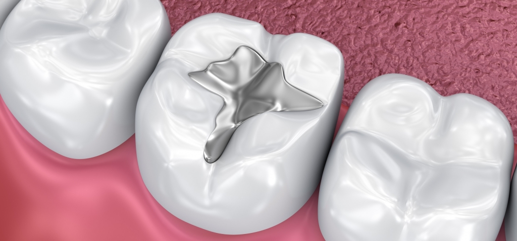 Welche ist die beste Zahnfüllung? - Donau Dental