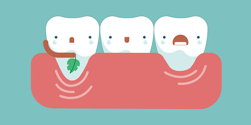 Was tun bei Zahnfleischrückgang? Symptome, Ursachen, Risiken, Behandlung und Prävention