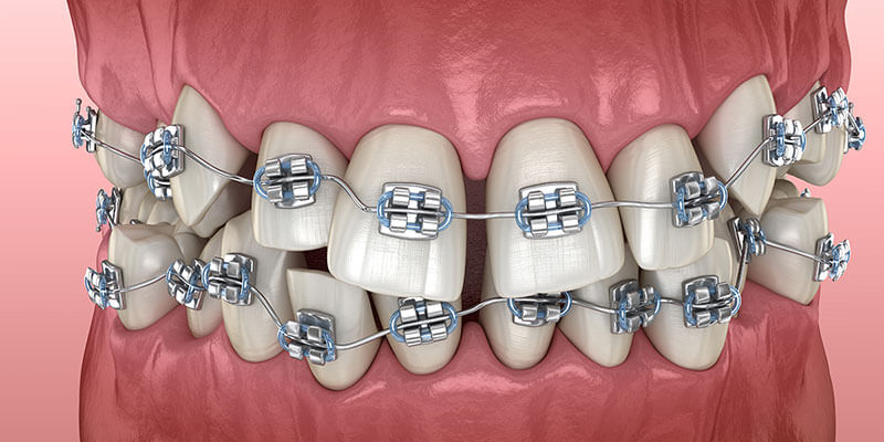 Zahnfehlstellungen bei Erwachsenen- Warum bekommen wir wieder schiefe Zähne?