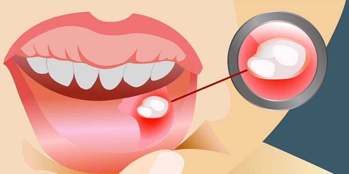 Aphthen Allgemeines, Ursachen, Symptome, Behandlung und Prävention