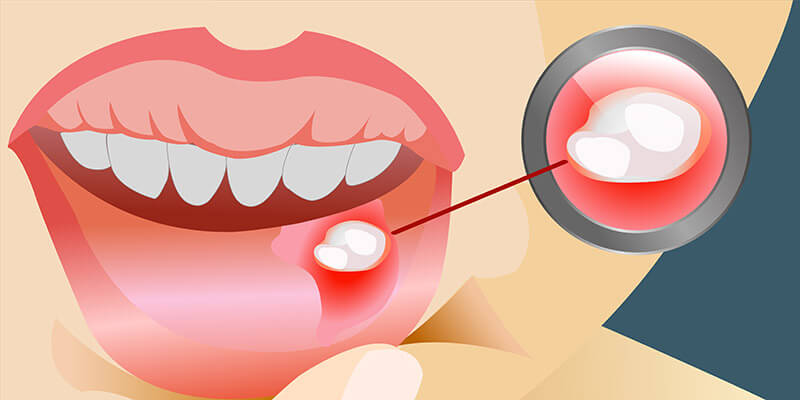 Aphthen- Allgemeines, Ursachen, Symptome, Behandlung und Prävention