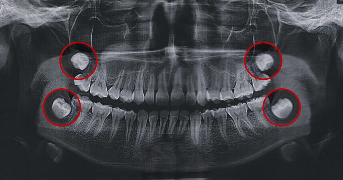 Alles, was Sie über Weisheitszähne wissen müssen!